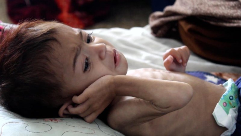 Afghanistan hospital struggling to save its starving babies 