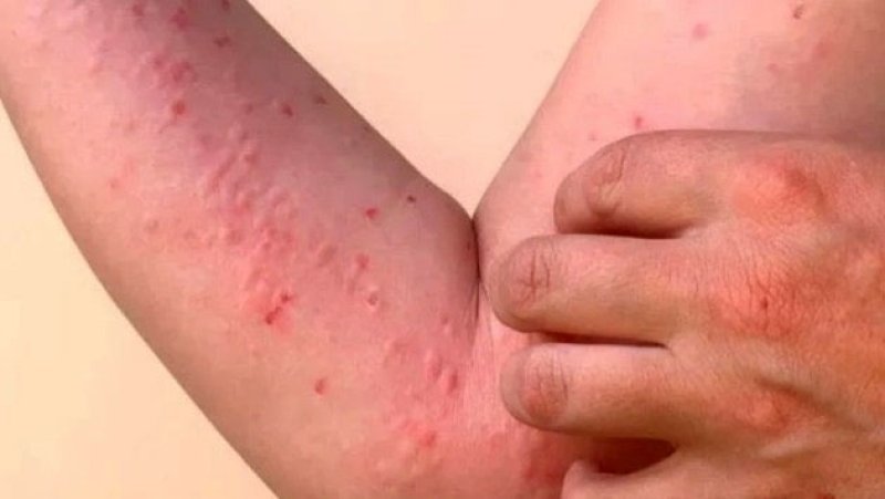 Residents urged to take precautions as Chikungunya cases