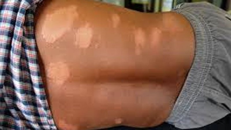 Health authorities stress early detection