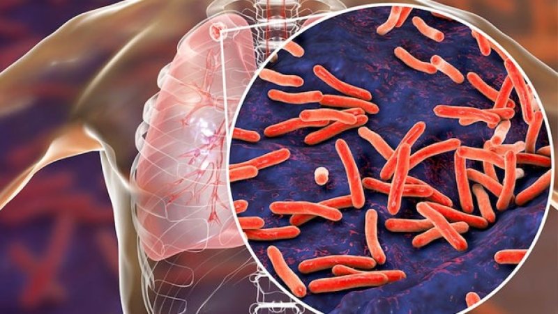 Over 2,000 Tuberculosis cases detected