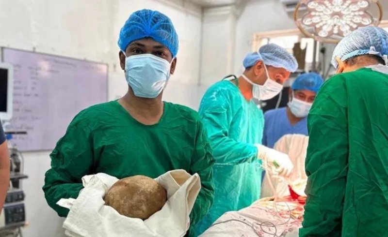 Sri Lanka doctors remove &lsquo;World&rsquo;s Largest&rsquo; bladder stone