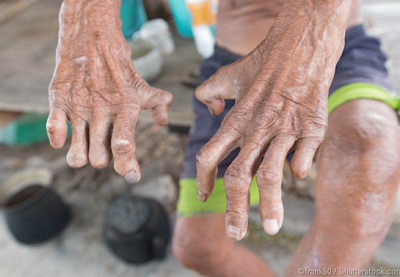 Sri Lanka logs over 1,500 leprosy cases in 2023