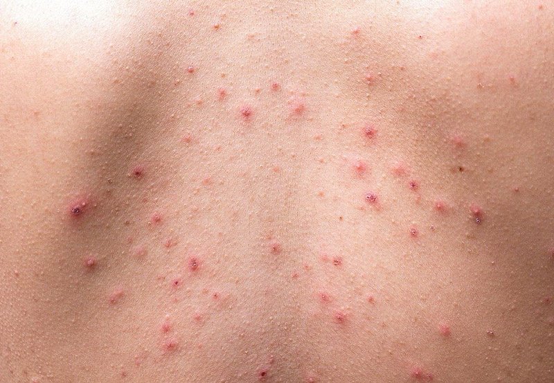 Surge in skin-related diseases sweeps across Sri Lanka