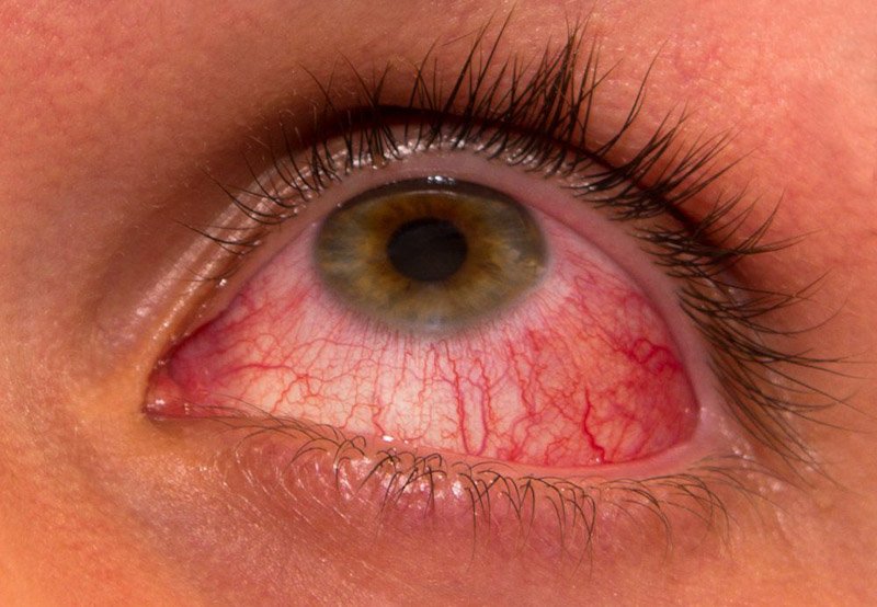 Eye disease sparks concerns in Colombo City