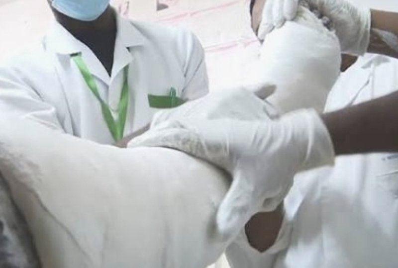 Patient raises concerns over plaster shortage at hospitals
