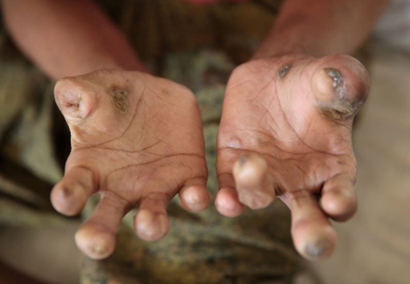 Surge in Leprosy cases sparks concern in Sri Lanka 